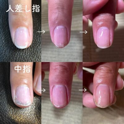 ピッチャーの爪