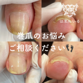 はまねいるの巻爪ケア